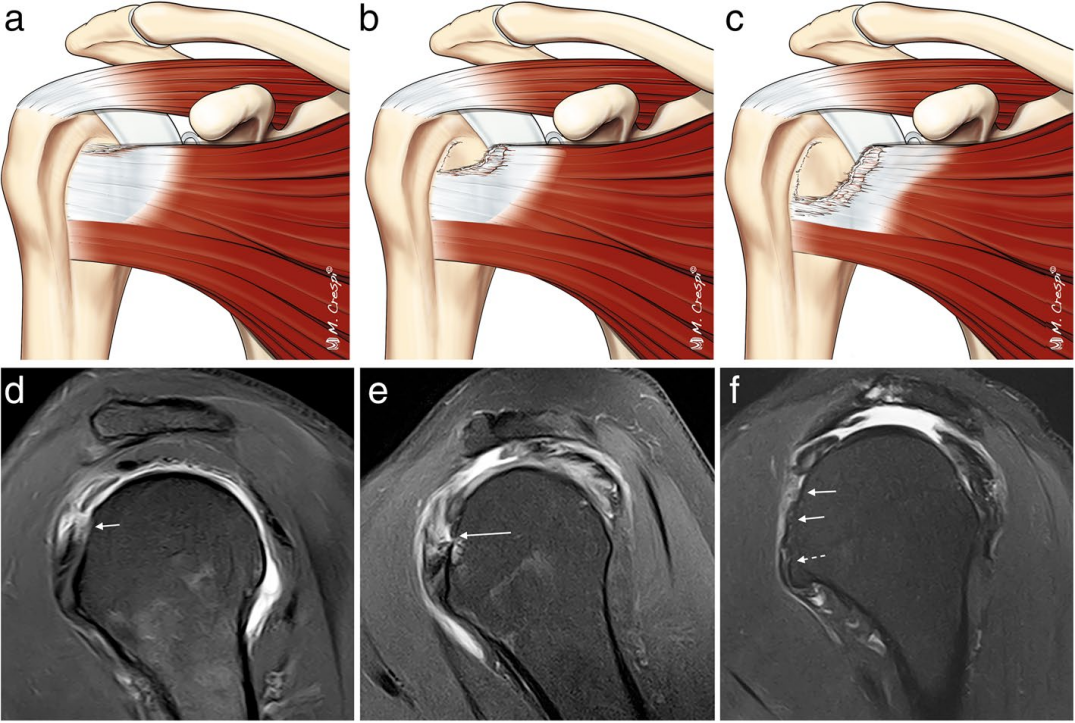 肩袖撕裂模式：磁共振成像及其手术相关性