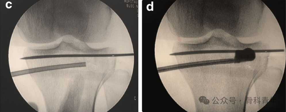 手术技巧｜“经皮球囊扩张成形术”治疗胫骨外侧平台塌陷型骨折