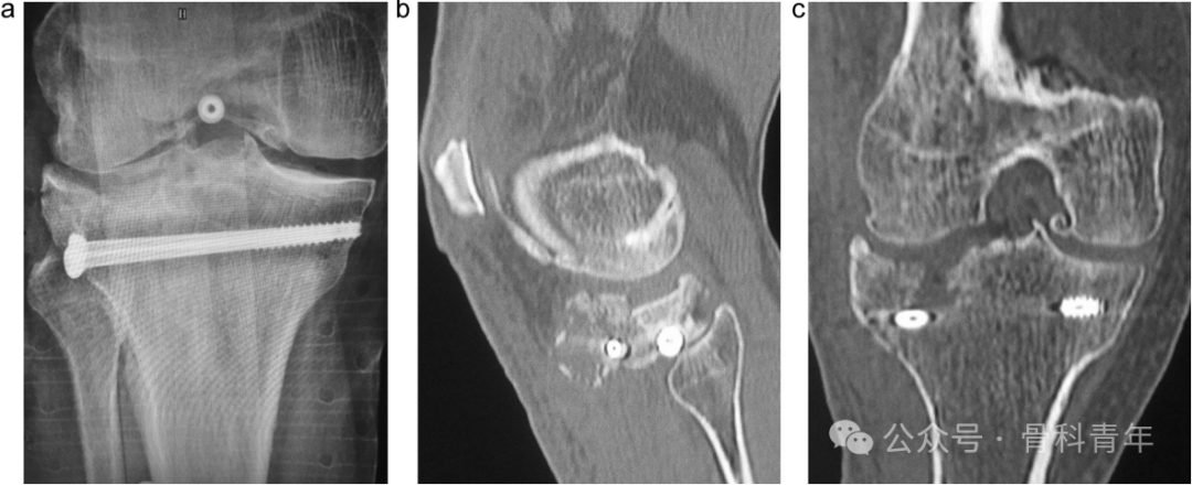 手术技巧｜“经皮球囊扩张成形术”治疗胫骨外侧平台塌陷型骨折
