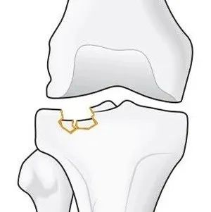 手术技巧｜“经皮球囊扩张成形术”治疗胫骨外侧平台塌陷型骨折