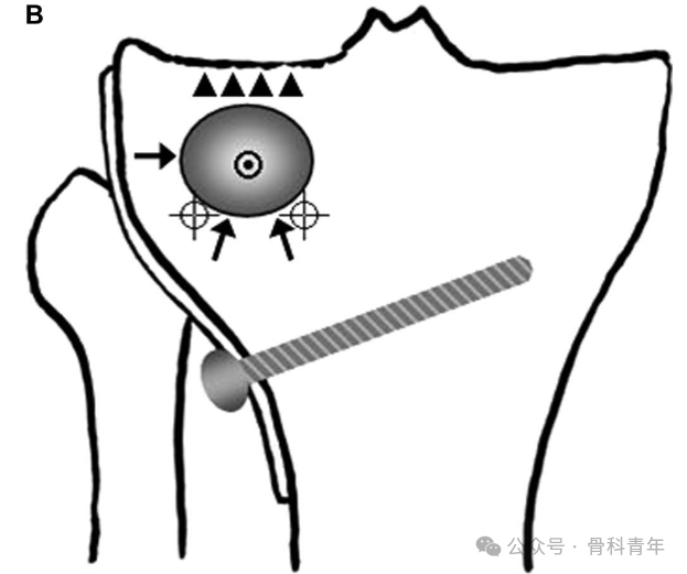 手术技巧｜“经皮球囊扩张成形术”治疗胫骨外侧平台塌陷型骨折