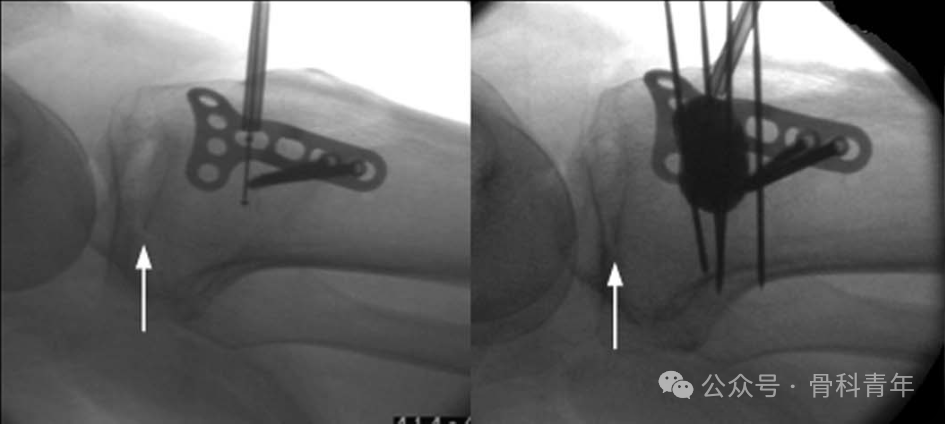 手术技巧｜“经皮球囊扩张成形术”治疗胫骨外侧平台塌陷型骨折