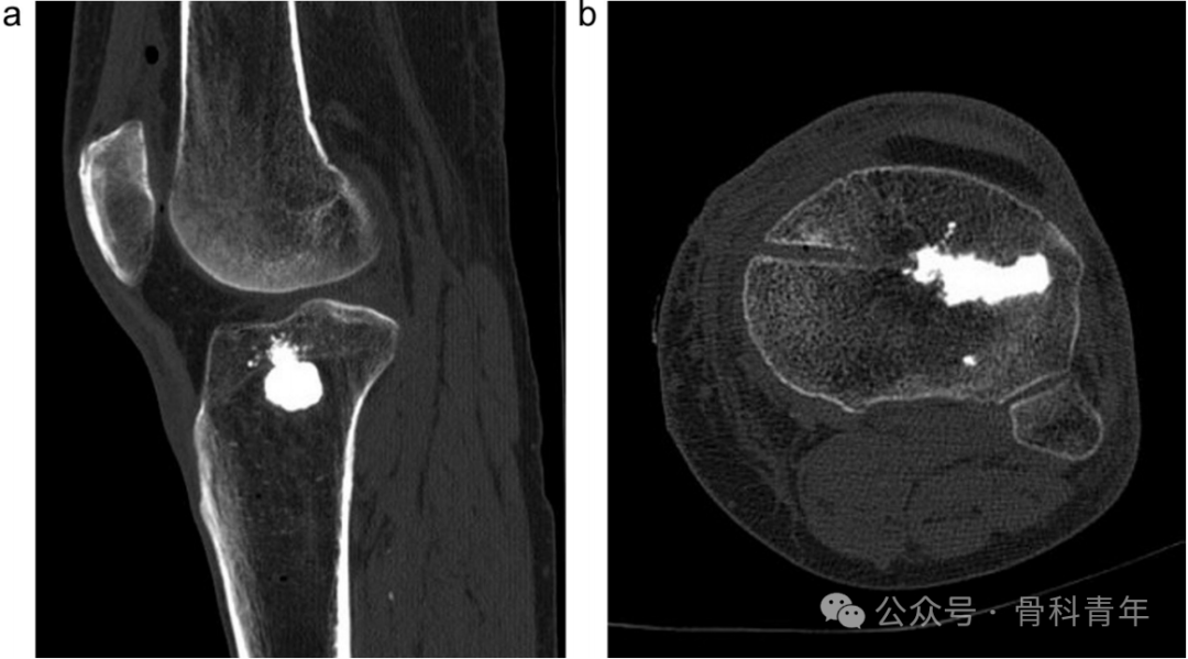 手术技巧｜“经皮球囊扩张成形术”治疗胫骨外侧平台塌陷型骨折