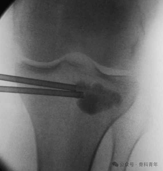 手术技巧｜“经皮球囊扩张成形术”治疗胫骨外侧平台塌陷型骨折