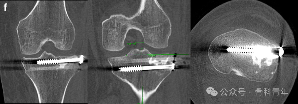 手术技巧｜“经皮球囊扩张成形术”治疗胫骨外侧平台塌陷型骨折