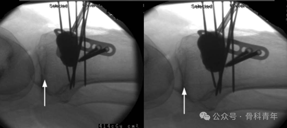 手术技巧｜“经皮球囊扩张成形术”治疗胫骨外侧平台塌陷型骨折
