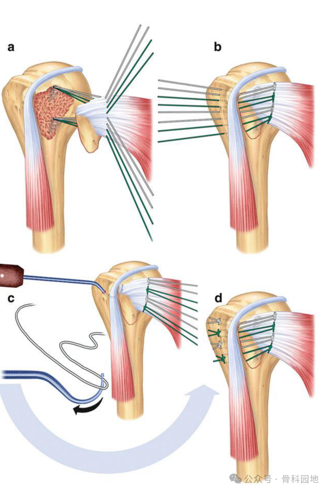 早读【手术技巧】肱骨大小结节骨折铆钉复位内固定技巧
