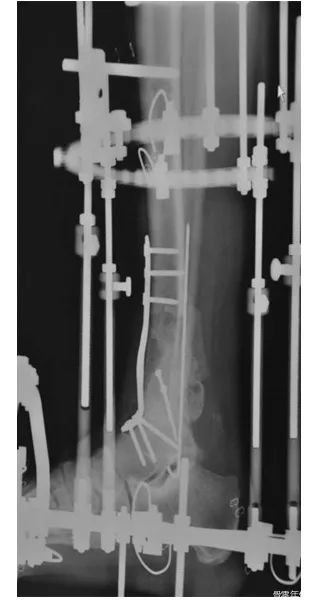严重粉碎性胫骨Pilon骨折的治疗：踝关节融合