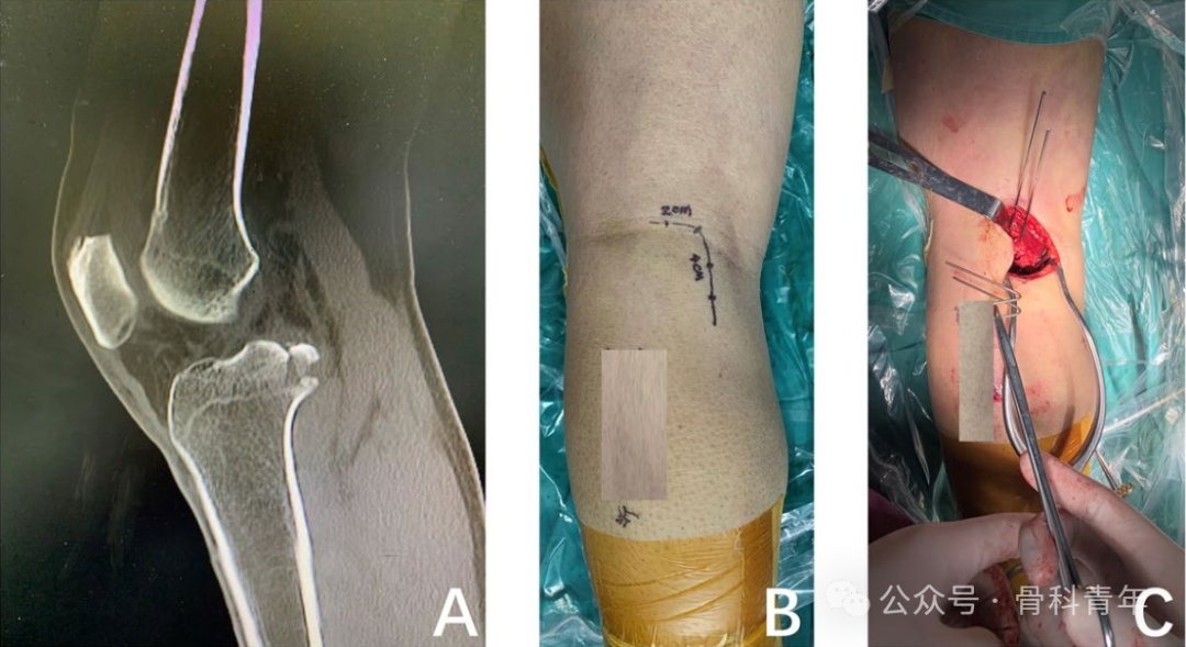 手术技巧｜克氏针自制“针钩结构”内固定治疗后叉止点骨折