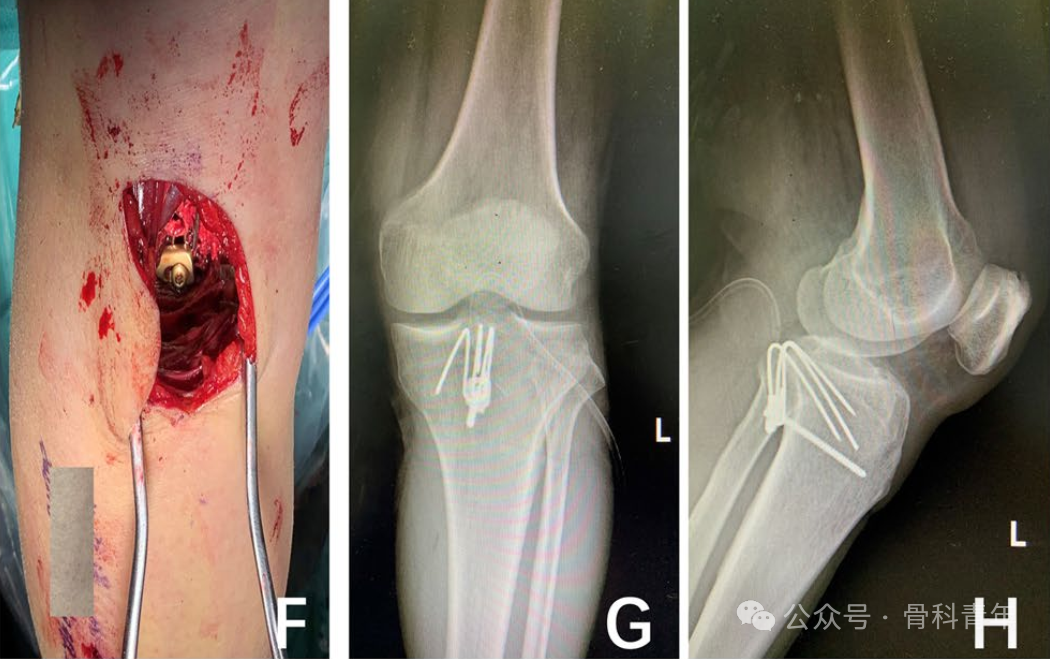 手术技巧｜克氏针自制“针钩结构”内固定治疗后叉止点骨折