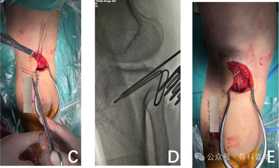 手术技巧｜克氏针自制“针钩结构”内固定治疗后叉止点骨折