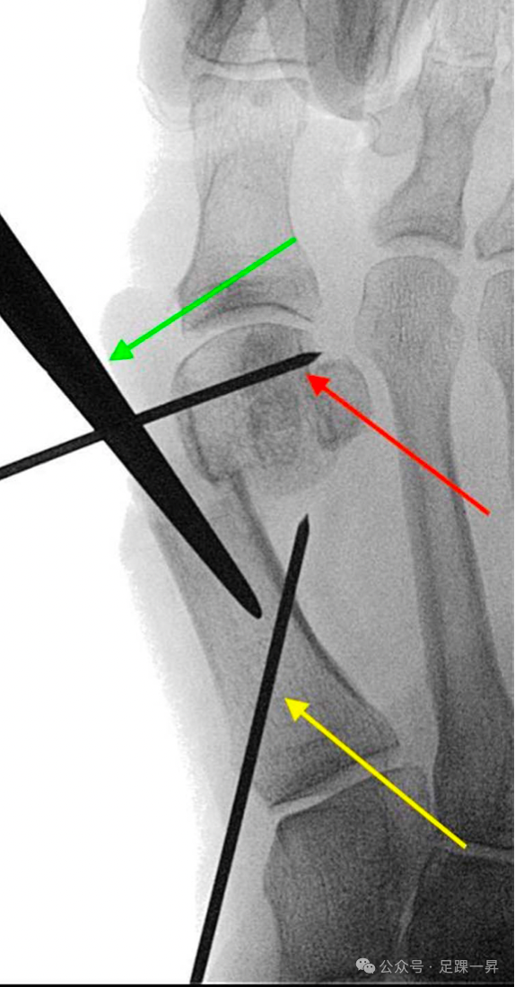 手术技巧｜第四代微创拇外翻技术