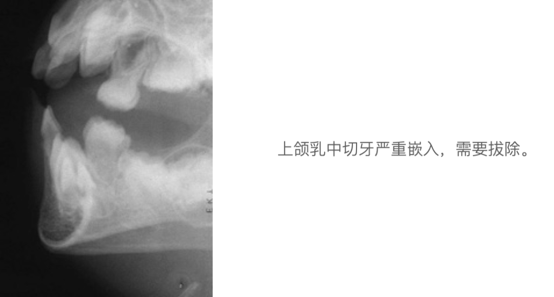 乳牙外伤的分类总结及处理办法