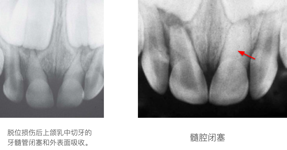 乳牙外伤的分类总结及处理办法