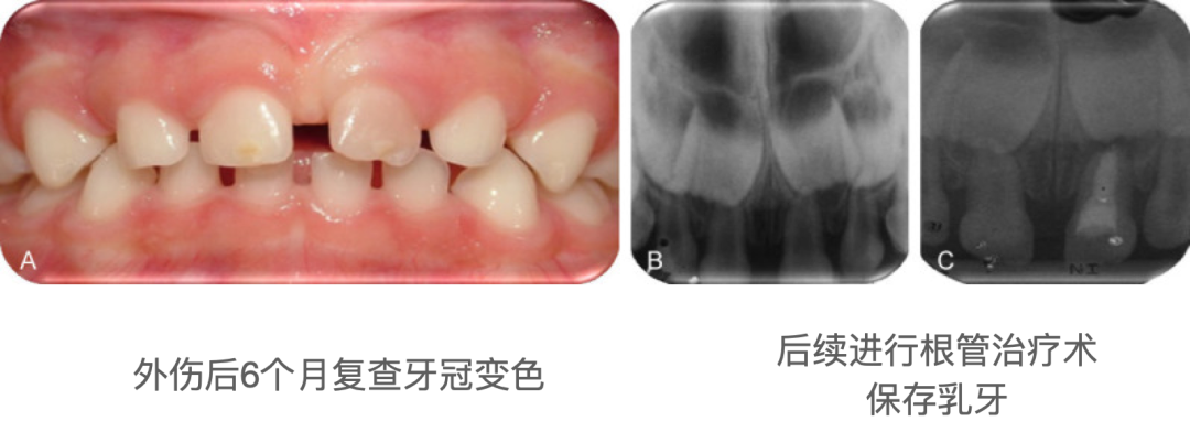 乳牙外伤的分类总结及处理办法