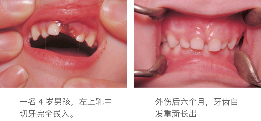 乳牙外伤的分类总结及处理办法