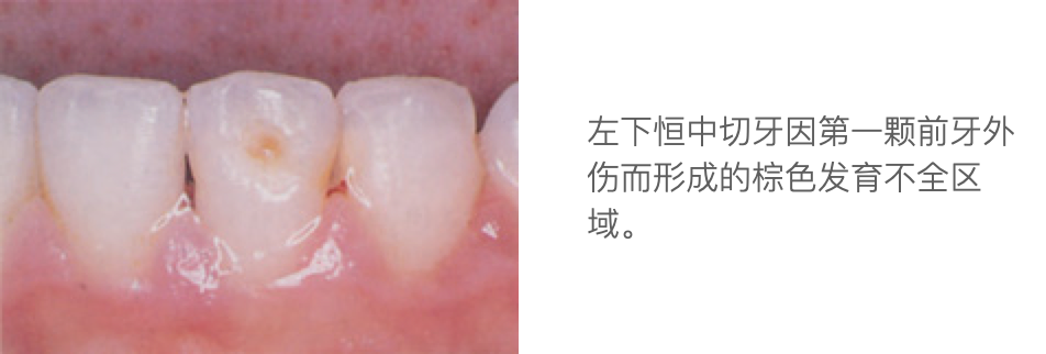 乳牙外伤的分类总结及处理办法