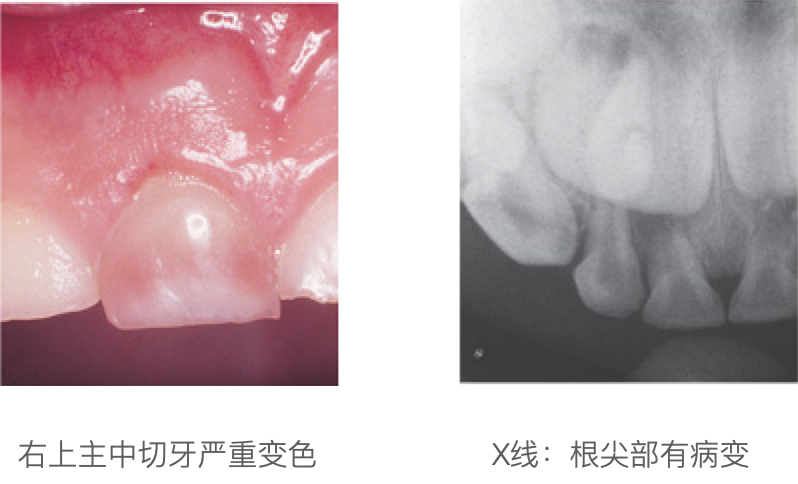 乳牙外伤的分类总结及处理办法