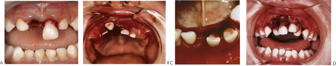 乳牙外伤的分类总结及处理办法