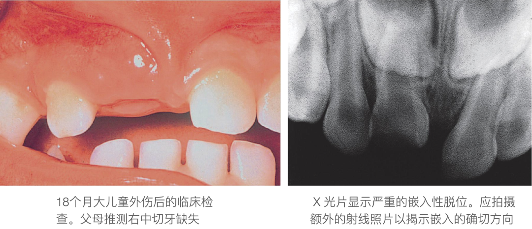 乳牙外伤的分类总结及处理办法