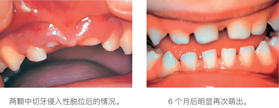 乳牙外伤的分类总结及处理办法