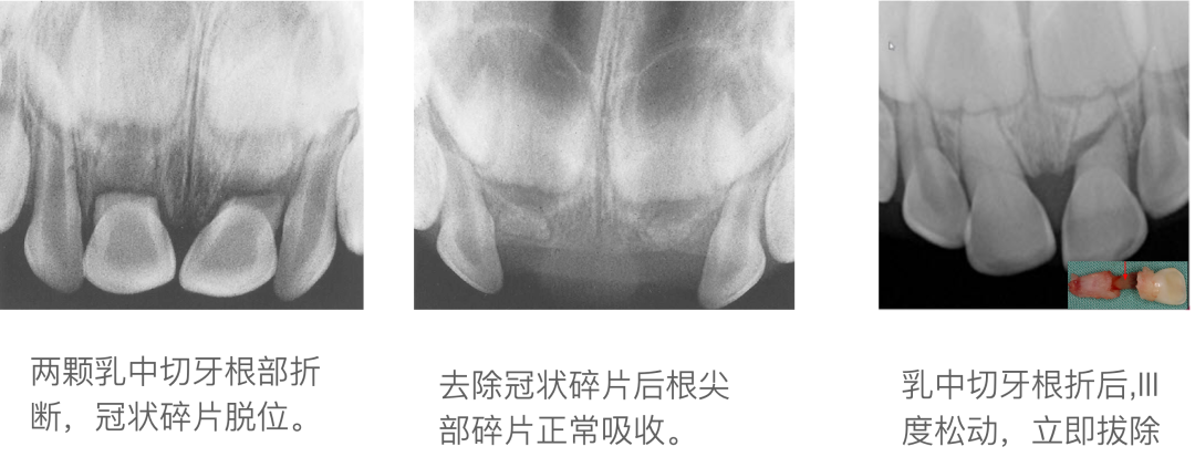 乳牙外伤的分类总结及处理办法