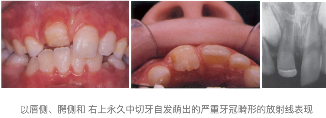 乳牙外伤的分类总结及处理办法