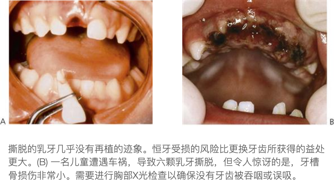 乳牙外伤的分类总结及处理办法