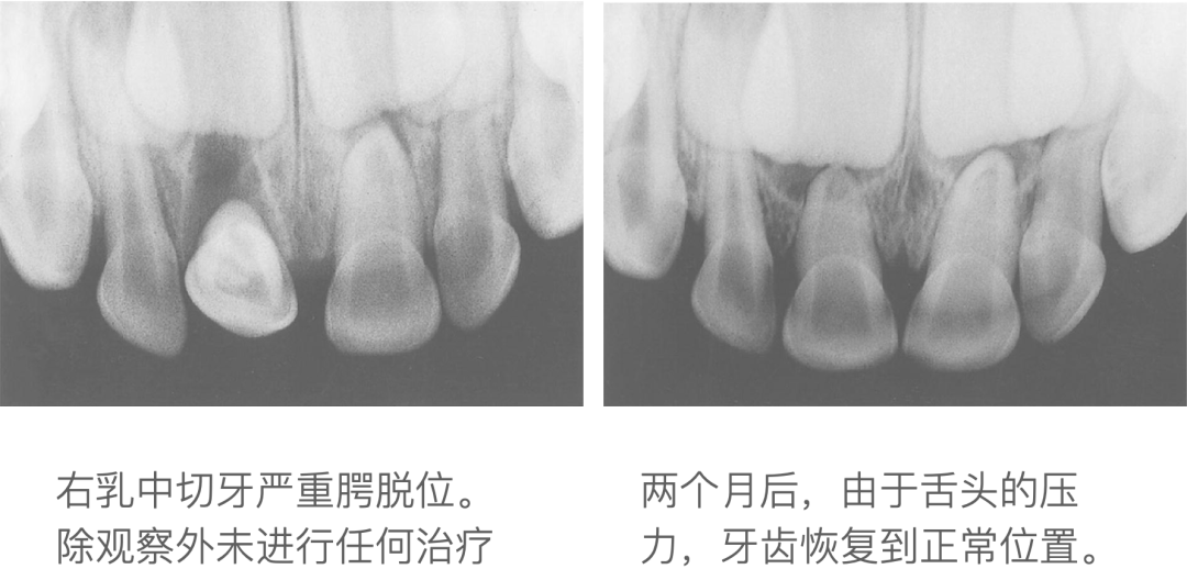 乳牙外伤的分类总结及处理办法