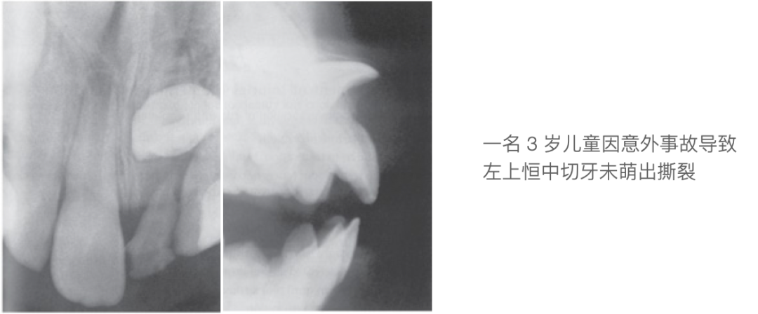 乳牙外伤的分类总结及处理办法