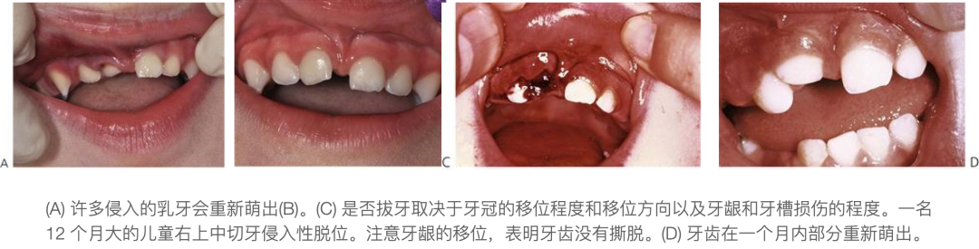 乳牙外伤的分类总结及处理办法