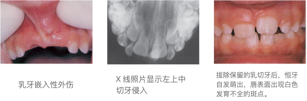 乳牙外伤的分类总结及处理办法