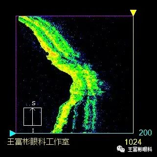 复杂性视网膜劈裂的分层识别