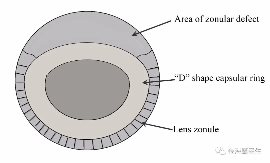 金海鹰医生：植入性囊袋拉钩的另一用途——重建囊膜支撑、植入睫状沟