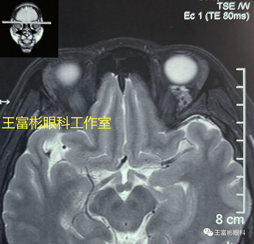 临床病例：眶内海绵状血管瘤MRI的几个影像特点