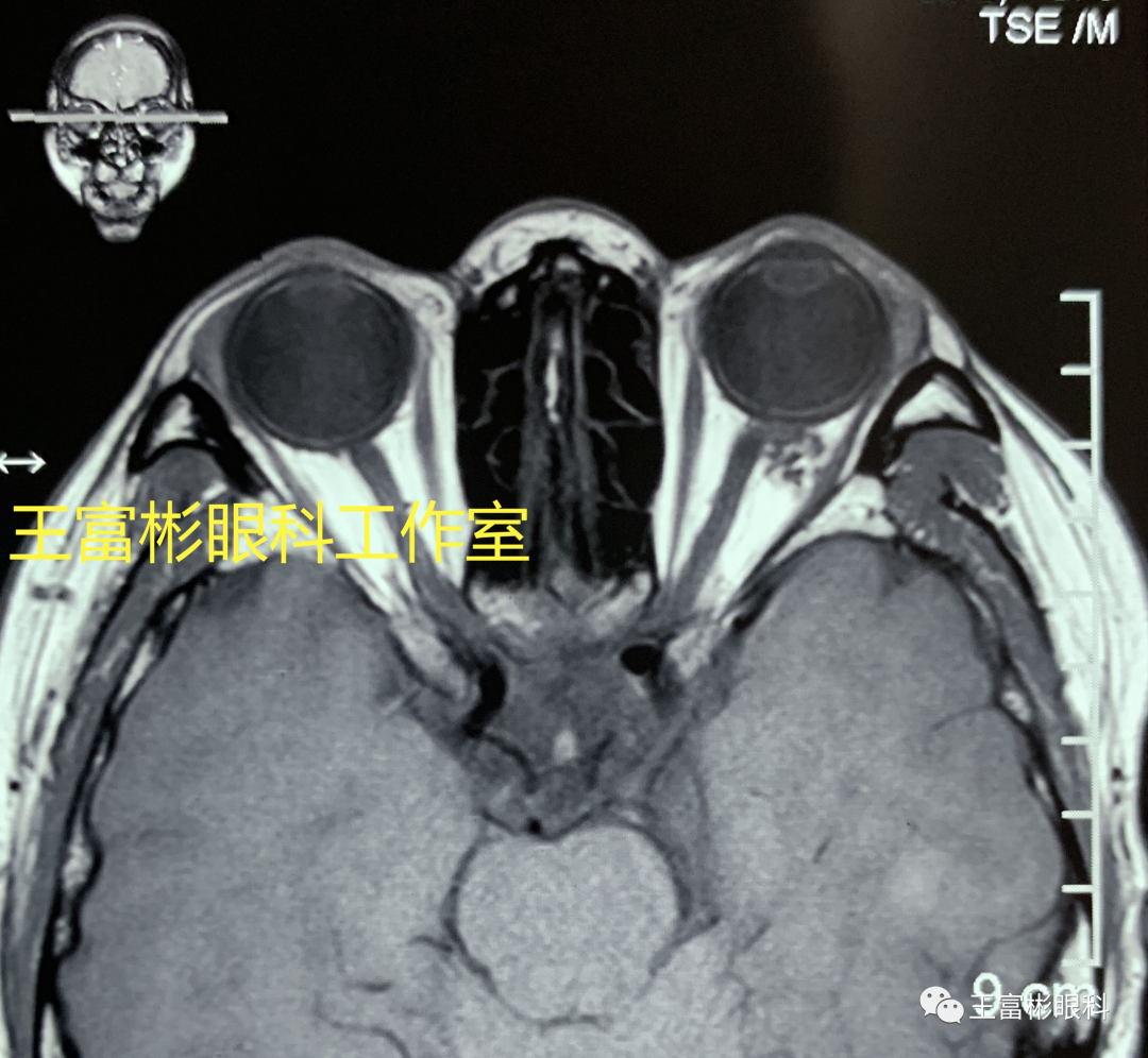 临床病例：眶内海绵状血管瘤MRI的几个影像特点