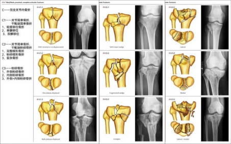 图文并茂，一文详解胫骨平台骨折的常见分型