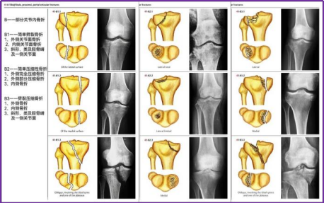 图文并茂，一文详解胫骨平台骨折的常见分型