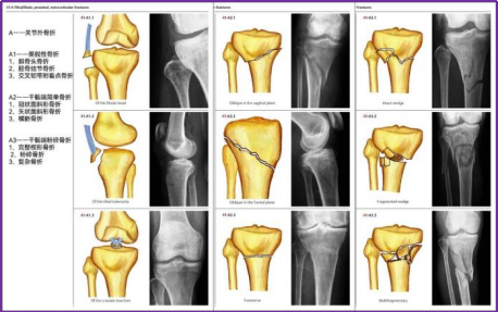 图文并茂，一文详解胫骨平台骨折的常见分型