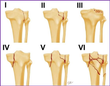 图文并茂，一文详解胫骨平台骨折的常见分型