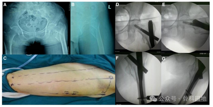 手术技巧｜“3-2-1”体表定位法在股骨粗隆间骨折中的应用