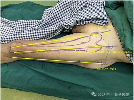 手术技巧｜“3-2-1”体表定位法在股骨粗隆间骨折中的应用