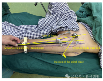 手术技巧｜“3-2-1”体表定位法在股骨粗隆间骨折中的应用