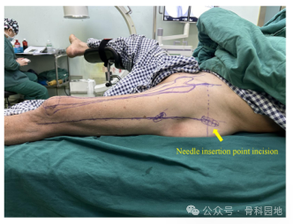 手术技巧｜“3-2-1”体表定位法在股骨粗隆间骨折中的应用