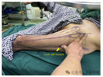 手术技巧｜“3-2-1”体表定位法在股骨粗隆间骨折中的应用
