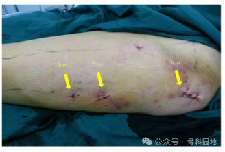 手术技巧｜“3-2-1”体表定位法在股骨粗隆间骨折中的应用