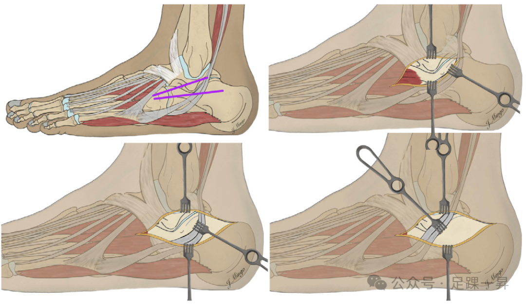 手术技巧｜经跗骨窦入路治疗跟骨骨折的西班牙经验