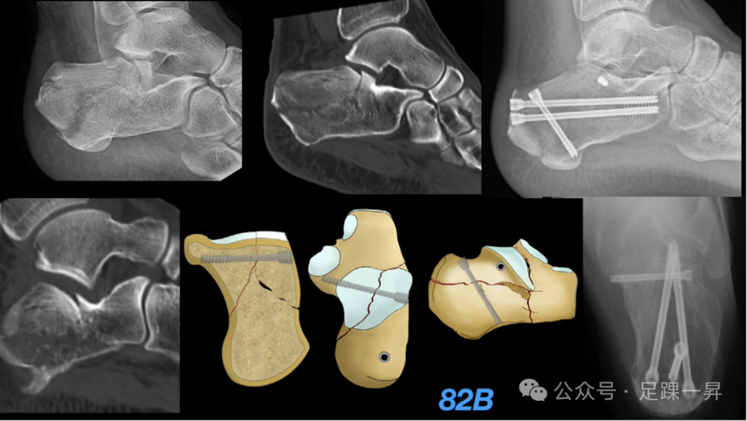 手术技巧｜经跗骨窦入路治疗跟骨骨折的西班牙经验
