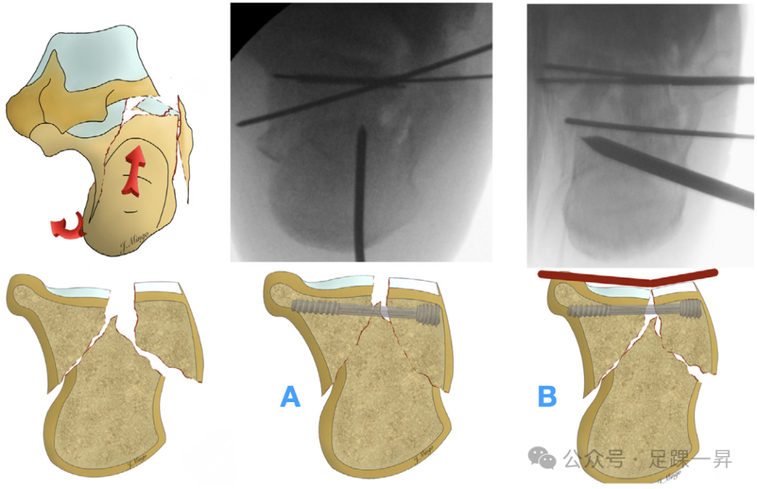 手术技巧｜经跗骨窦入路治疗跟骨骨折的西班牙经验