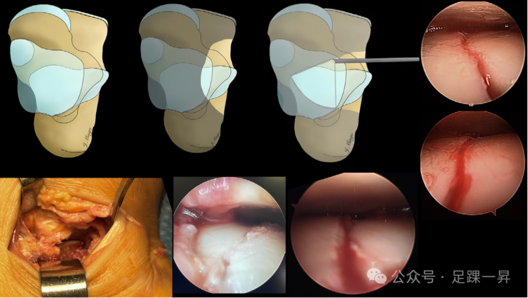 手术技巧｜经跗骨窦入路治疗跟骨骨折的西班牙经验